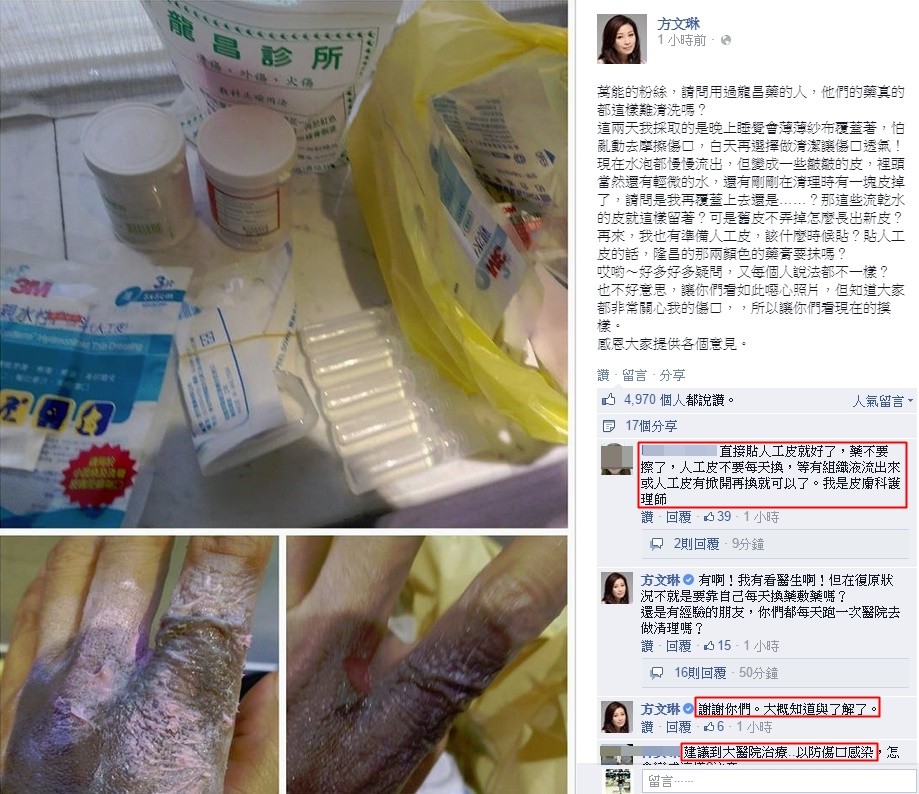 方文琳被90度热水烫伤 就医后手发黑羞露「恶心」照