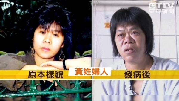 清秀女罹肢端肥大症10年变脸 名制作人周游是1例