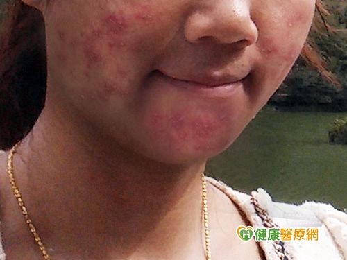 猪皮打汁敷脸 女子脸部红肿过敏 | ETtoday健康