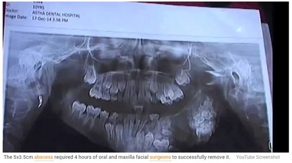 印度「牙瘤」又作怪! 7岁男孩上颚被80颗牙塞爆
