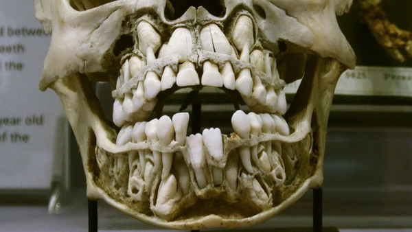 d90085 幼童口腔內的恐怖真相　乳牙根部接著一排恆齒《ETtoday 新聞雲》