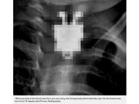 阿拉伯孩童誤食不明物品　X光片讓醫生當場驚聲尖叫