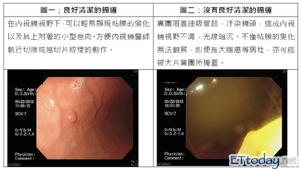 肠镜的功能在於检查