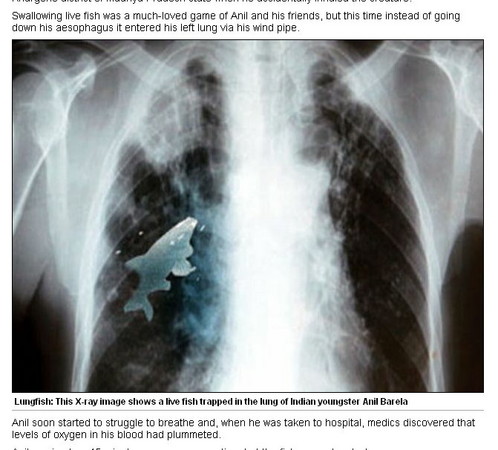 d97124 印度傳有男童將活魚吸入肺　X光片照出清晰魚影