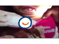 嘴裡有東西在鑽！　巴西女童牙齦「養」15條活蛆