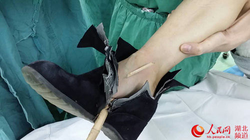 穿高跟鞋摘桔子 没站稳被20公分竹枝刺穿脚板