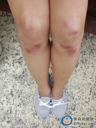 舞蹈生膝盖受伤图片图片