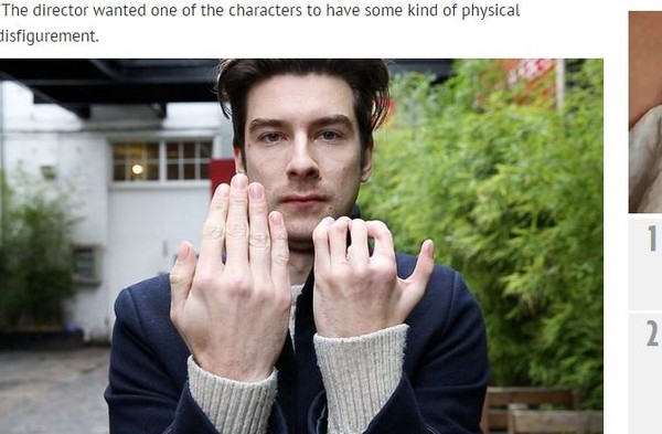 国际中心/综合报导 英国一名罹患波兰氏症候群(richard stott)的男子