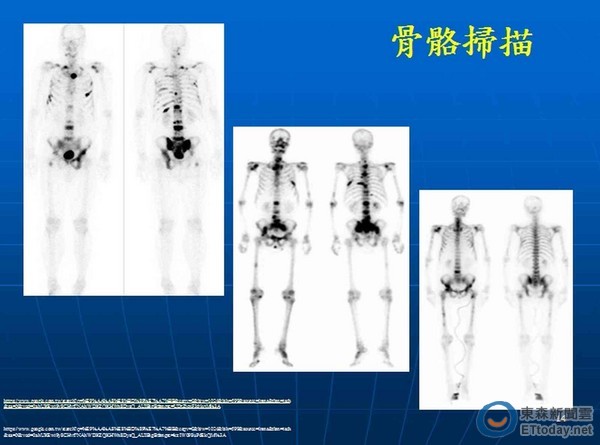 透过骨扫描等影像学检查,可以检查出癌症骨转移问题.