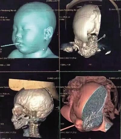 筷子刺穿喉咙图片图片