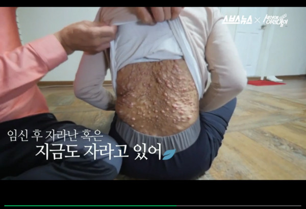 玄熙妈妈在怀孕后,背部就渐渐长出肉瘤.(图/翻摄自naver)