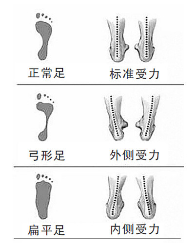 跟著腳型挑鞋子 弓形足選彈性厚底,八字腳別穿軟底!