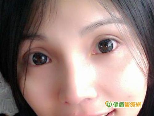 瞳孔放大片勿久戴 恐导致失明