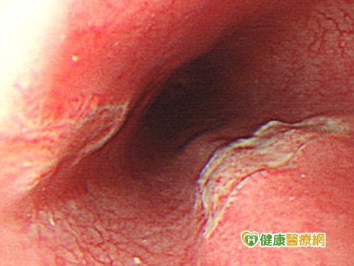 食道溃疡的症状图片图片