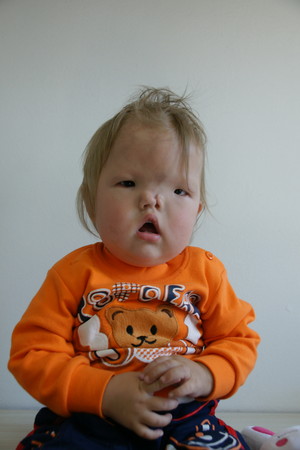 的头皮下有个洞,意味著 桑贾除了样貌不同之外,身体也要小心谨慎呵护