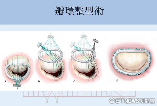 二尖瓣修補術 心臟二尖瓣閉鎖不全治療主流