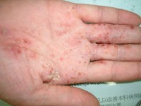 入秋汗皰疹患者增一成　用錯「洗手乳」會讓症狀更嚴重