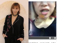 女歌手南韓旅遊「跌倒撞鋼椅毀容」　牙齒斷裂嘴縫23針