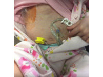 英2歲女童長腦瘤化療超過60次　小小身體插滿管