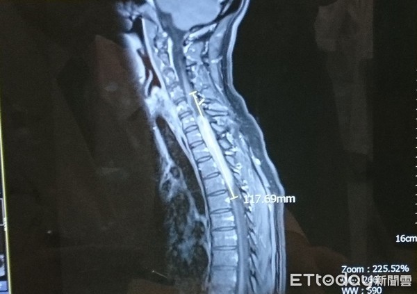 脚酸走路易跌倒! 女长12公分「脊髓瘤」.没医生