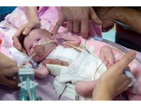 勇敢小生命！女嬰心臟長在外面　3次手術後奇蹟活下來