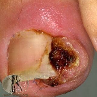 ettoday健康雲 同時有嵌甲的急性甲溝炎(凍甲,ingrown toenails)