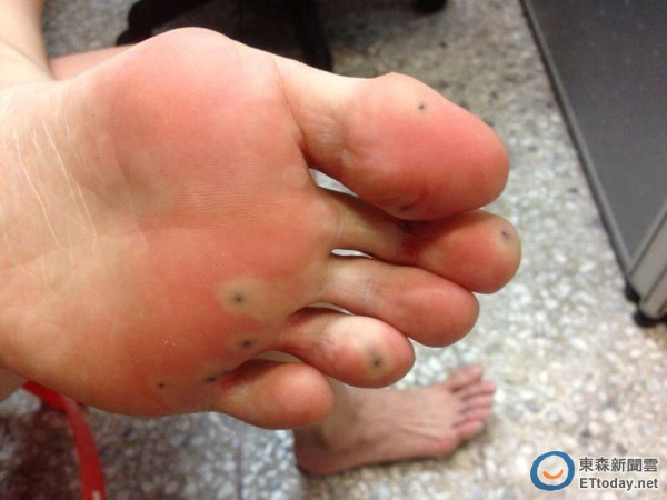 夏语心血溅绿岛 鱼咬水母电,希腊脚遭海胆刺崩溃落泪