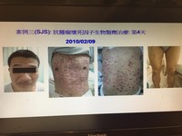 腳痛吃藥竟過敏　「T細胞風暴」讓他全身潰爛、指甲掉光