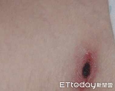 被咬一口致死率60%！清明掃墓防「恙蟲」偷襲...做好這3件事