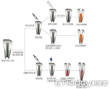 牙神經血管再生術讓牙齒起死回生　成功率超過9成