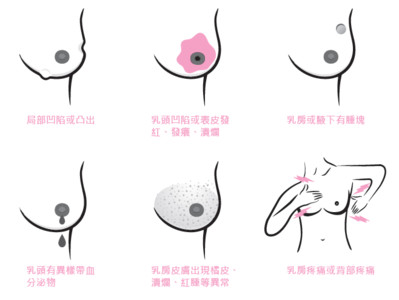 圖解乳癌！乳房出現這些變化該留意