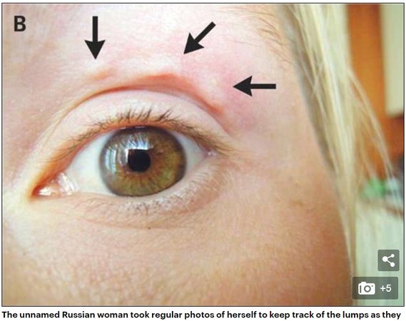 ▼ 眼周长白色斑点,医生开刀拉出超长寄生虫.