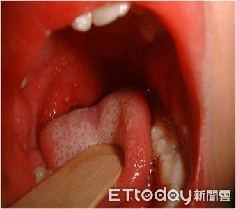 腸病毒重症創6年新高！　1歲女童感染竟引發「腦膜炎」