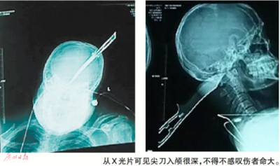 「後腦勺插尖刀8公分深」　廣州男冷靜騎車報案