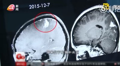 16歲女腦中藏「9CM裂頭蚴」　醫師：「養兩周」再活捉