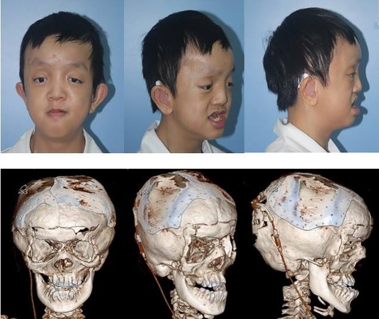 ▼罕见疾病克鲁松症(crouzon syndrome 患者阿嘉.