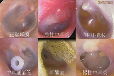 耳朵悶塞、耳朵痛癢怎麼辦? 專業醫師解答