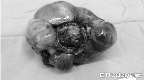 恶性畸胎瘤图片