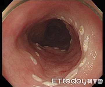 符合「3因子」食道癌風險高126倍　愛喝烈酒的你當心了！