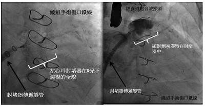 預防中風　「經皮左心耳封堵術」降低二次發生