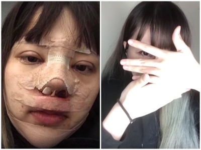 插畫家「超直白」認整型! 拆紗布「真貌現形」網驚:差點認不出