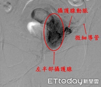 攝護腺肥大免開刀！「動脈阻塞術」手插導管　傷口僅針孔大