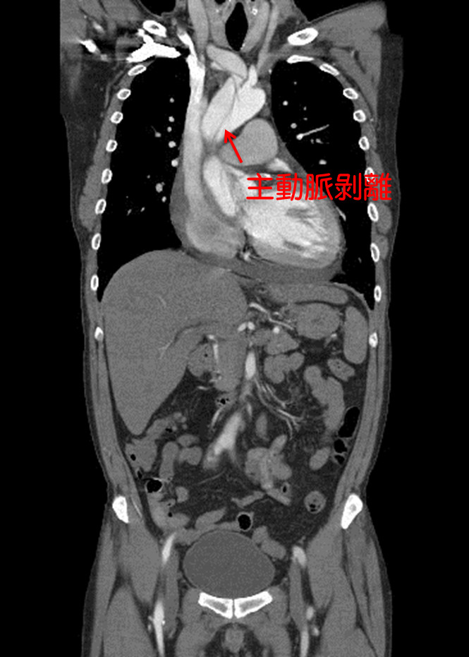 ▲▼患者主動脈剝離影像。(圖/國泰醫院提供) ▲▼患者主動脈剝離影像。(圖/國泰醫院提供)