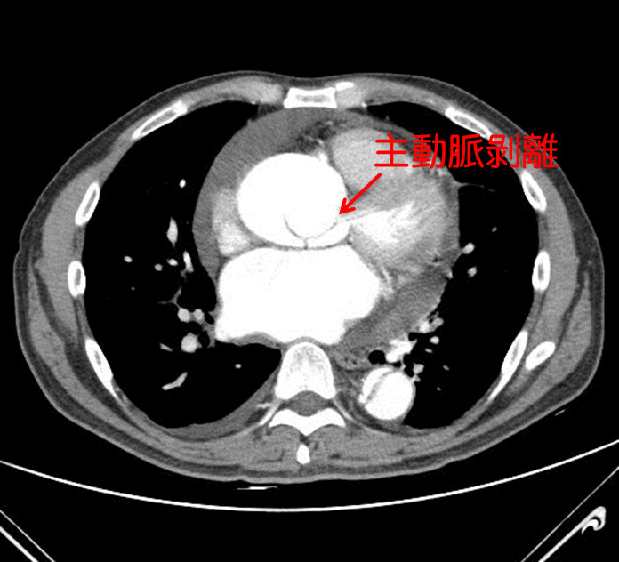 ▲▼患者主動脈剝離影像。(圖/國泰醫院提供) ▲▼患者主動脈剝離影像。(圖/國泰醫院提供)