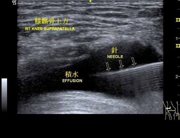 ▲▼ 膝關節積水的超音波影像。（圖／吳鑑倫醫師提供）