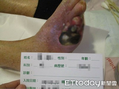 蚊子咬一口「慘變壞死筋膜炎」！她腳爛成墨綠色恐截肢