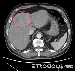 男到院檢查出肝腫瘤　不知自己Ｂ肝帶原引起