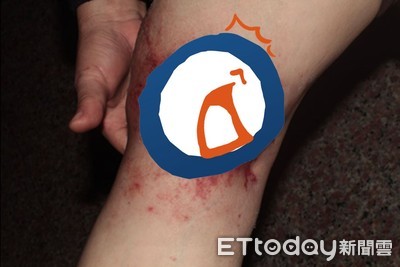 別信偏方!燙傷敷「黑面馬」染蜂窩性組織炎...醫:小心潰爛險截肢