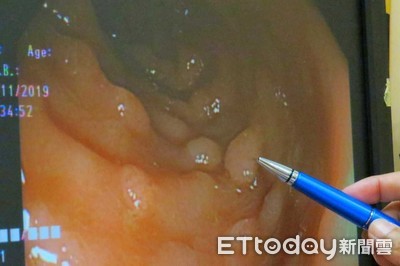 3兄弟一年內「全罹大腸癌」！醫曝恐怖遺傳機率：媽媽4年前就確診
