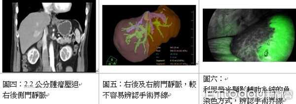 ▲王家豪醫師強調，新型ICG螢光顯影輔助系統，幫助外科醫師同時集術前檢測、術中診斷及手術過程治療於一役，精準切除腫瘤，提高手術成功率。（圖／記者林悅翻攝，下同）